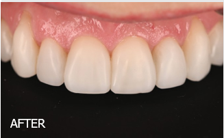 From Worn to Refined: Injectable Composite Veneers with Luna Flow